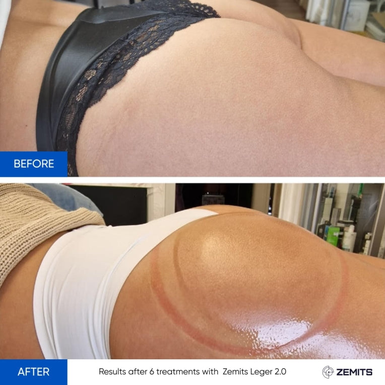 Zemits Leger 2.0 Sistema de Vacío con Copas XXL en el Set