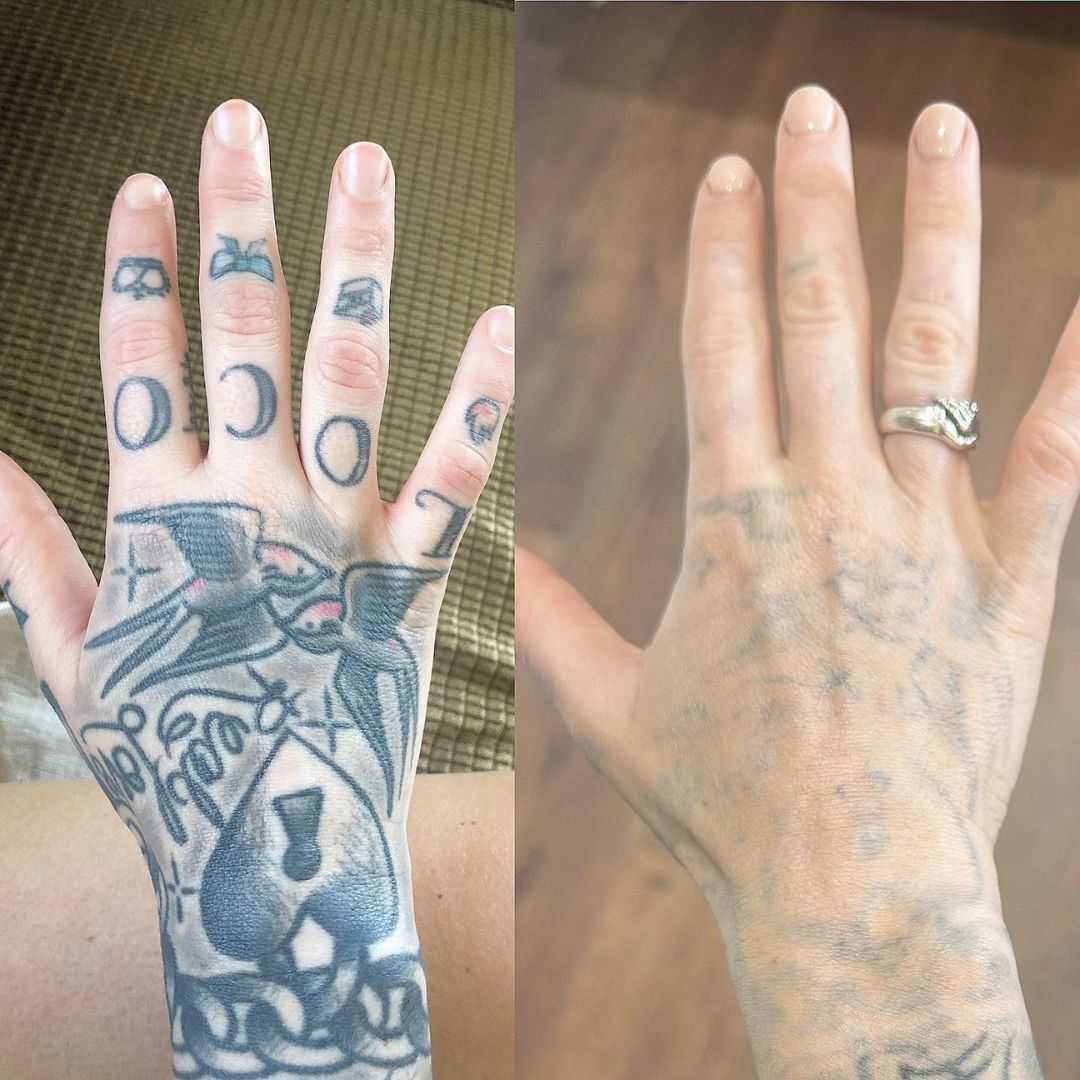 Zemits YAGenix Láser Nd:YAG conmutado por Q