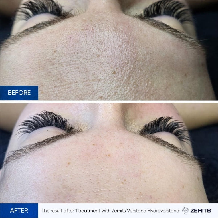 Zemits HydroVerstand PRO Sistema 7-en-1 HydroDiamond™