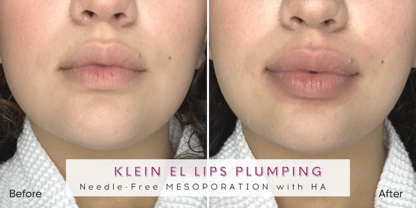 Zemits Klein EL Sistema de Electroporación