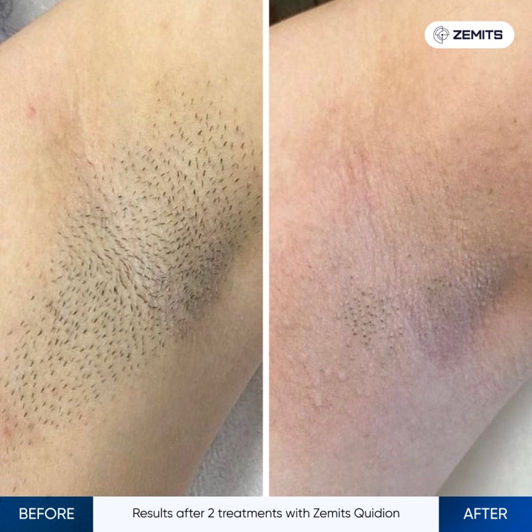Zemits Quidion Láser de Diodo Para Depilación