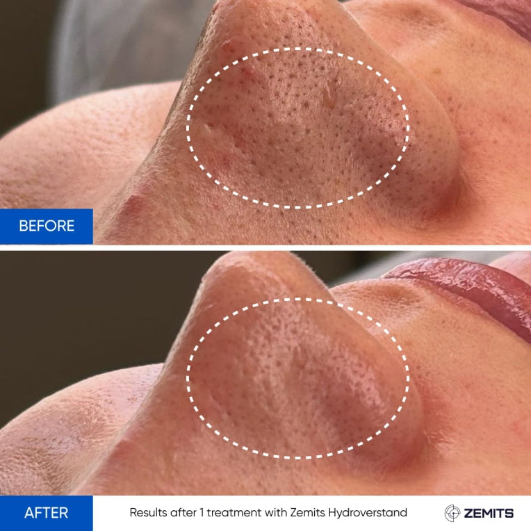 Zemits HydroVerstand PRO Sistema 7-en-1 HydroDiamond™