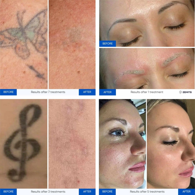 Zemits YAGenix Láser Nd:YAG conmutado por Q